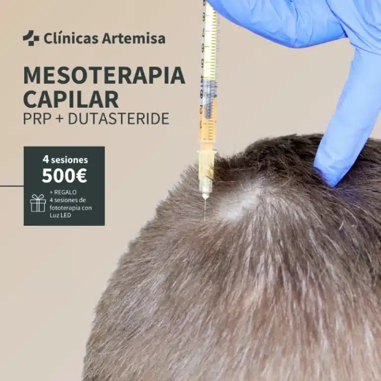 mesoterapia capilar