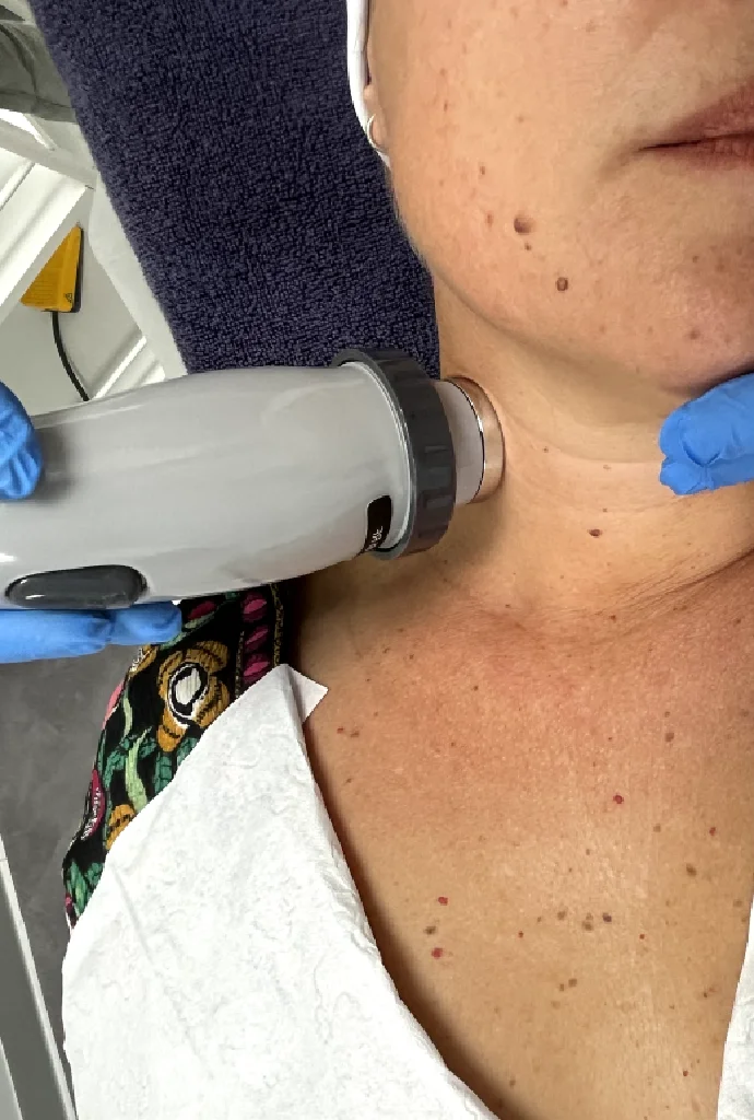 paciente aplicándose radiofrecuencia en el cuello