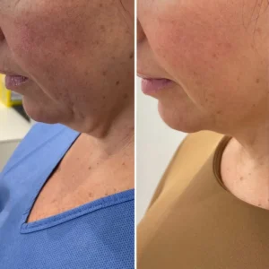 resultados endolifting