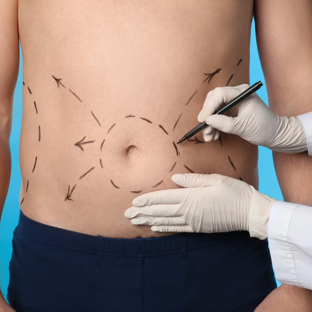 abdominoplastia en Clínicas Artemisa