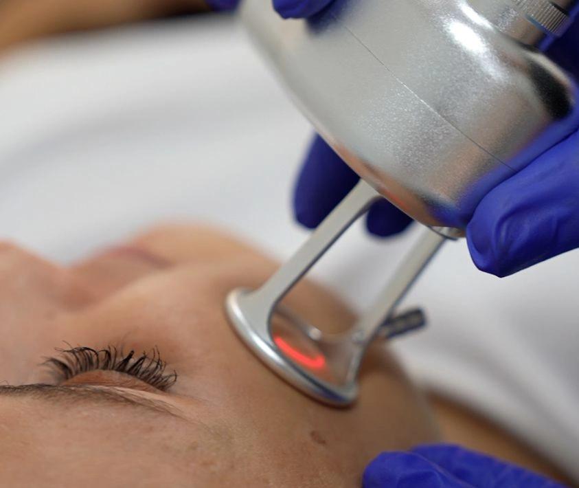 De Acné Sesiones De Laser Co2 Fraccionado Láser CO2 Para El