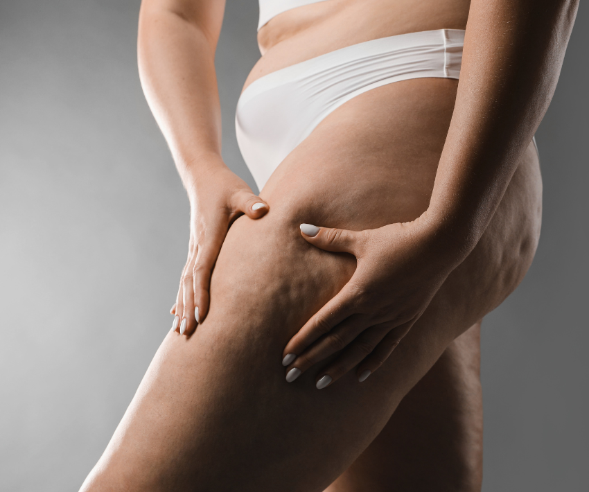 eliminar lipedema