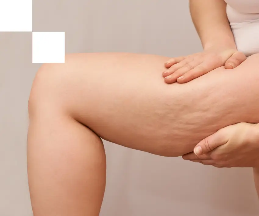 lipedema en piernas