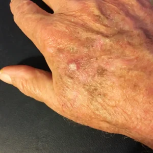 Queratosis actínica