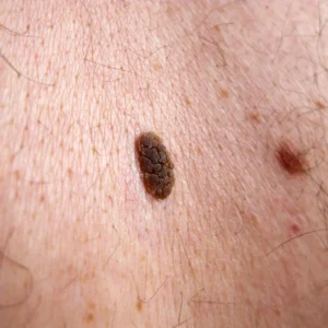 queratosis seborreica