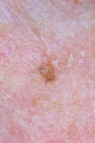 tratamiento queratosis