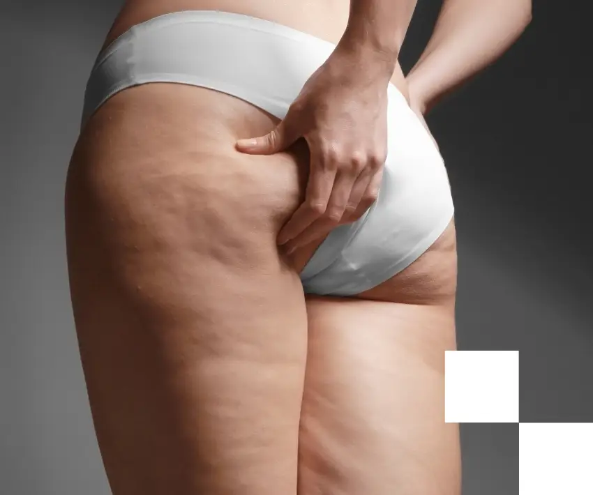 tratar lipedema en sevilla