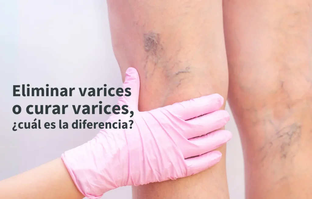 eliminar varices