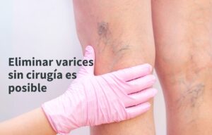 eliminar varices sin cirugía