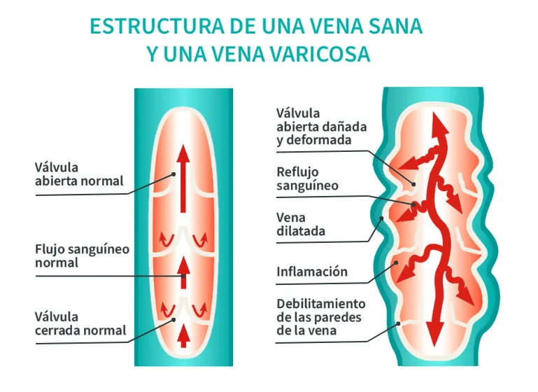 estructura de las venas sanas y de las venas con varices