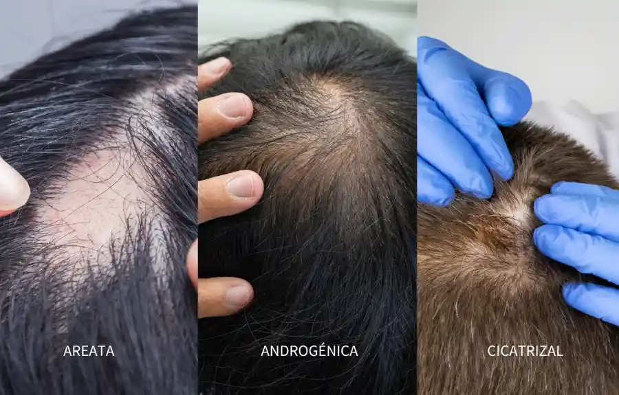 tipos de alopecia