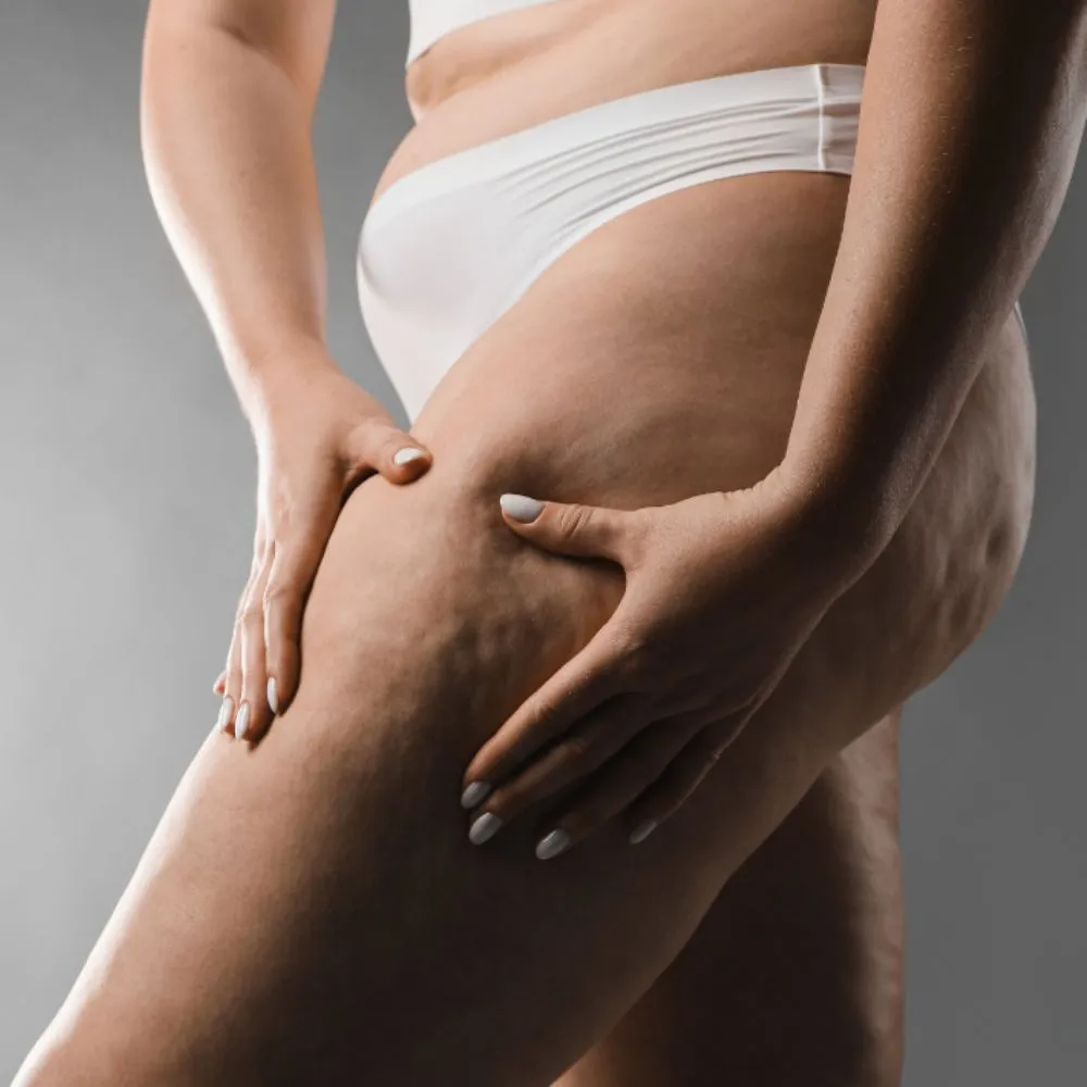 tratamiento para el lipedema