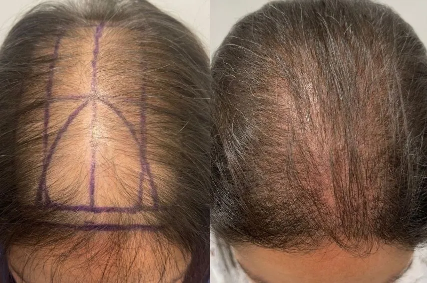 antes y despues injerto capilar