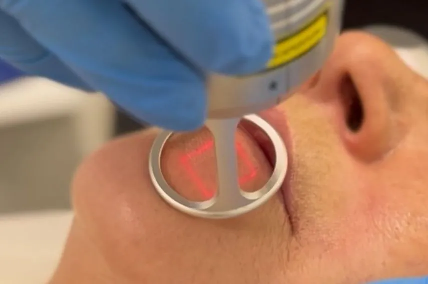 peeling quimico facial