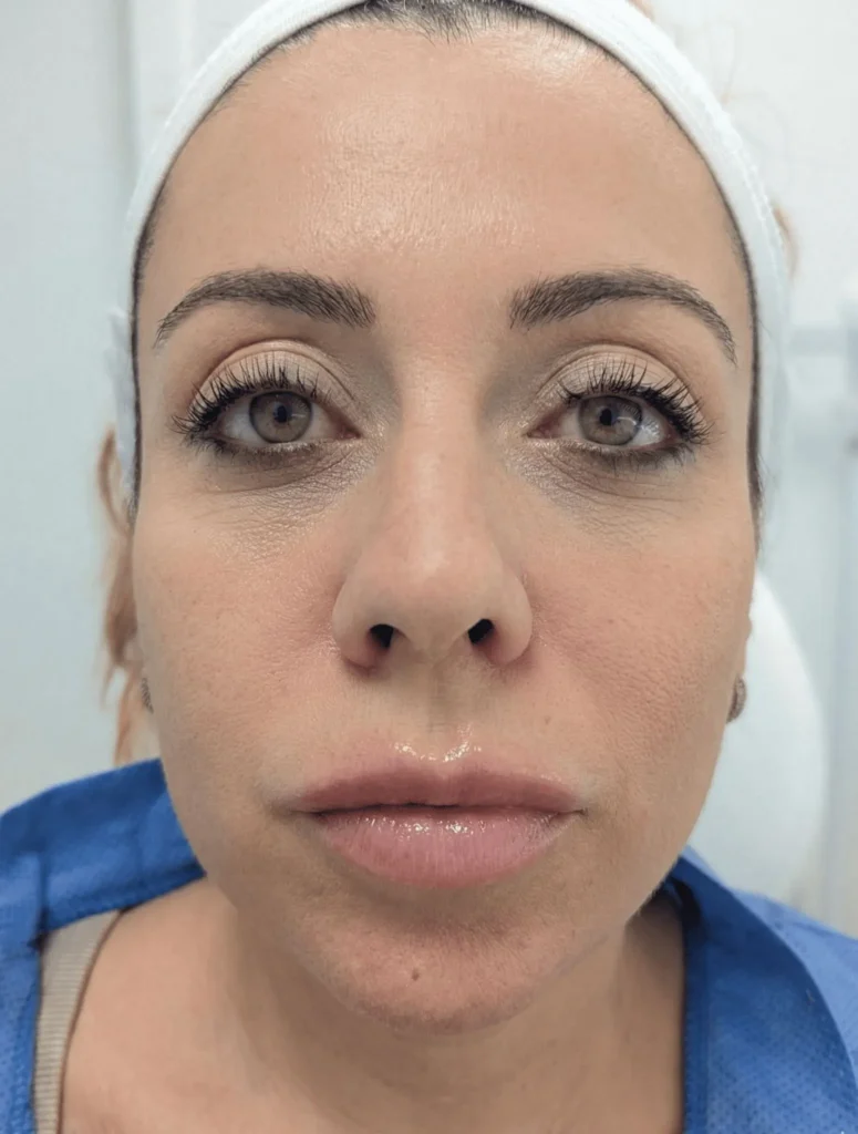 hidralips antes y despues