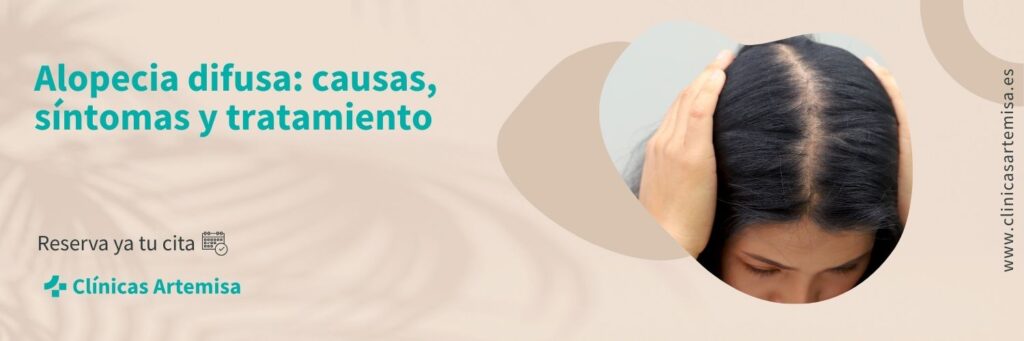 alopecia difusa