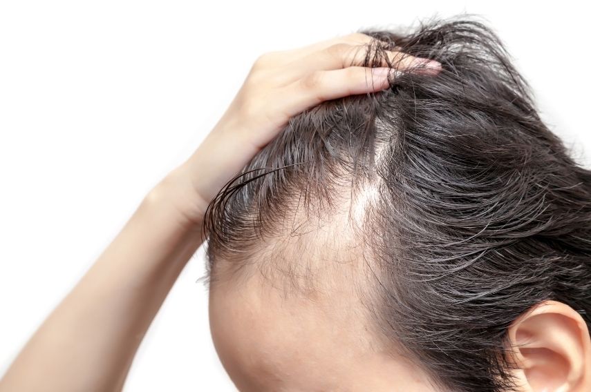 alopecia difusa hombre