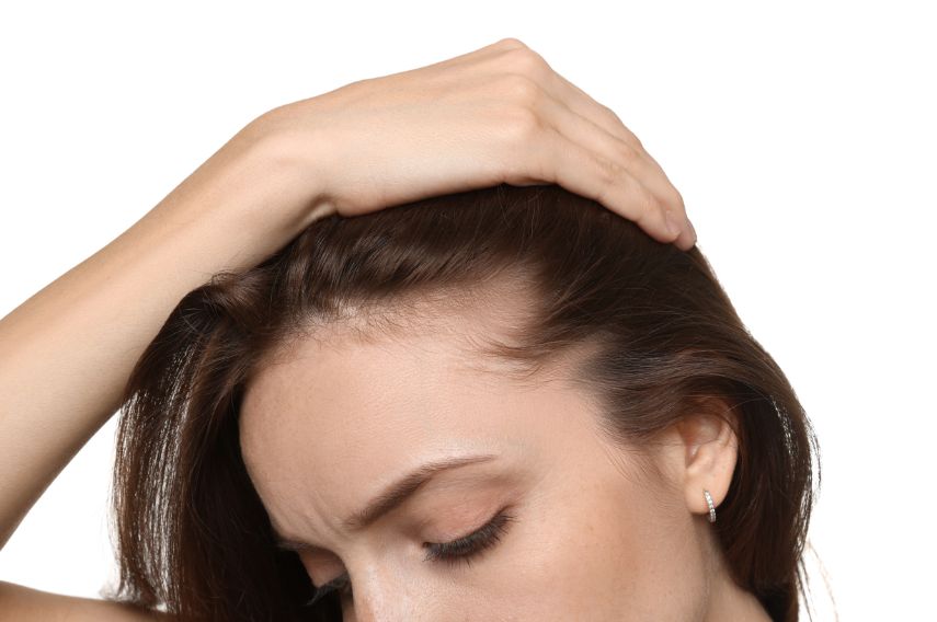 alopecia difusa mujeres