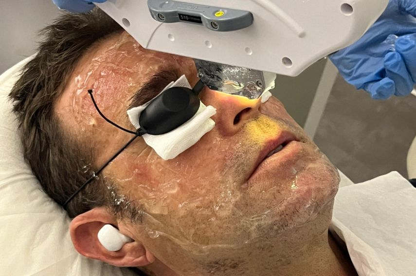 tratamiento ipl para manchas