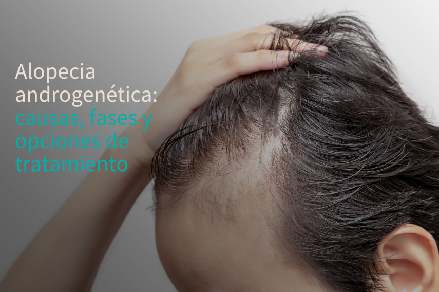 alopecia androgenetica
