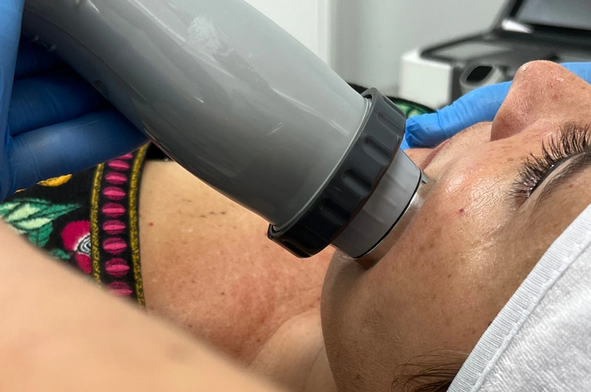 radiofrecuecia facial