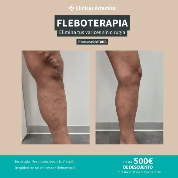 Fleboterapia sevilla