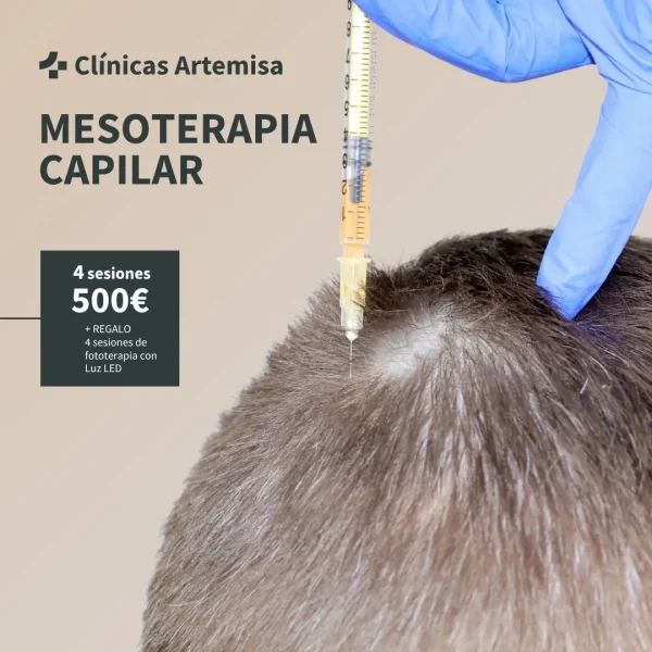 mesoterapia capilar en Sevilla