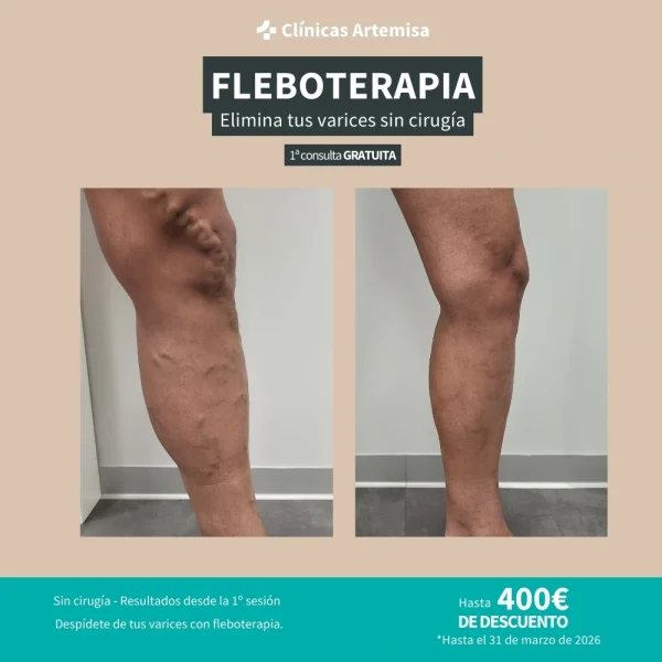 promoción tratamiento de varices marzo