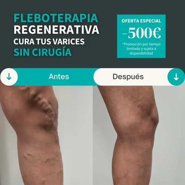 fleboterapia regenerativa para el tratamiento de varices